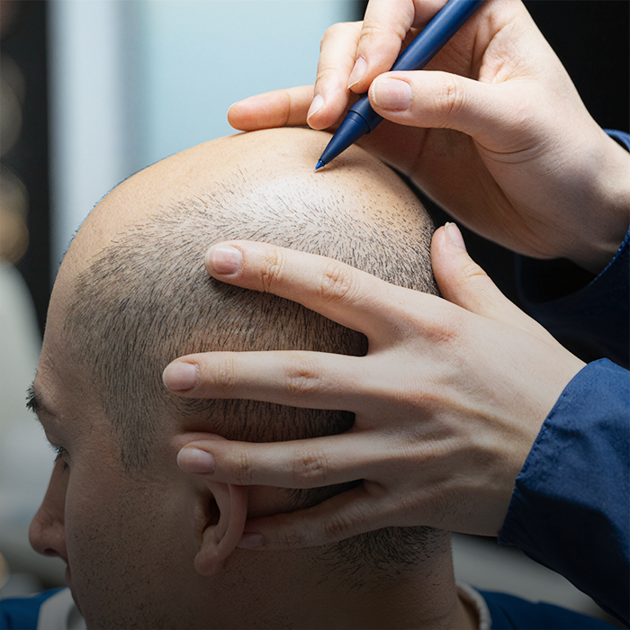 Mega Session Hair Transplant