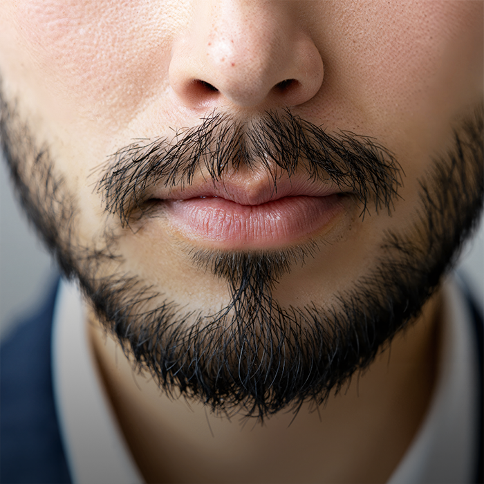 Mega Session Hair Transplant