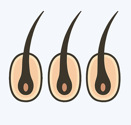 FUE Hairline Correction
