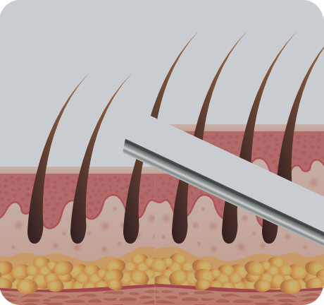 Forehead Reduction Surgery