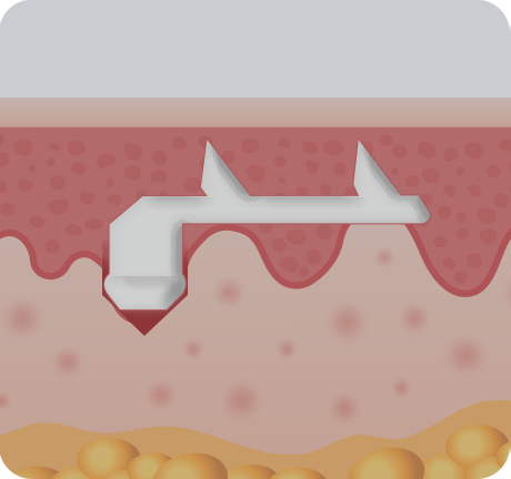 Forehead Reduction Surgery
