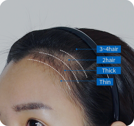 Hairline Micrografting