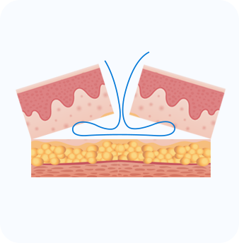 Follicular Unit Transplantation (FUT)