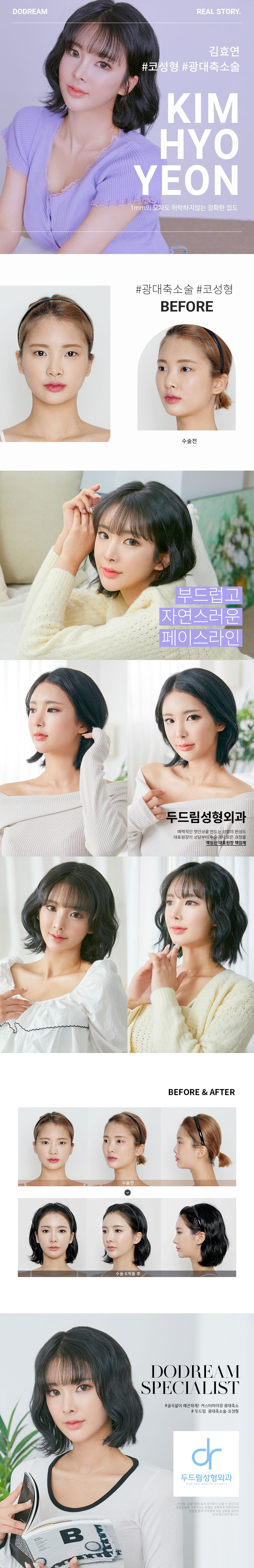210406_김효연2(코+광대축소술)_리얼스토리.jpg